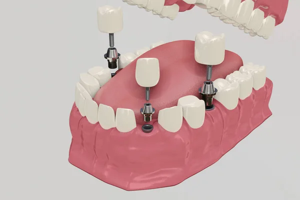 Zubní implantáty Procedura léčby. Lékařsky přesný 3D ilustrační zubní protézy koncept. — Stock fotografie