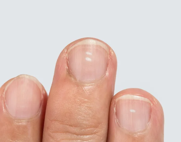 White Spots And Vertical Ridges On The Fingernails Stock Photo By