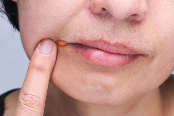 La queilitis angular es un tipo de inflamación común de los labios. — Foto de Stock