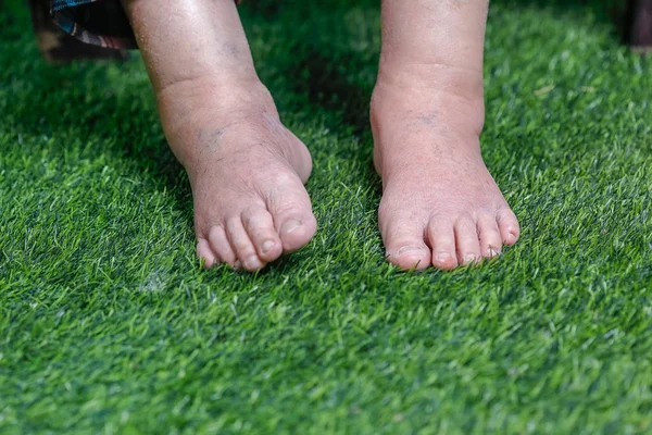 高齢者女性裸草に足の腫れ — ストック写真