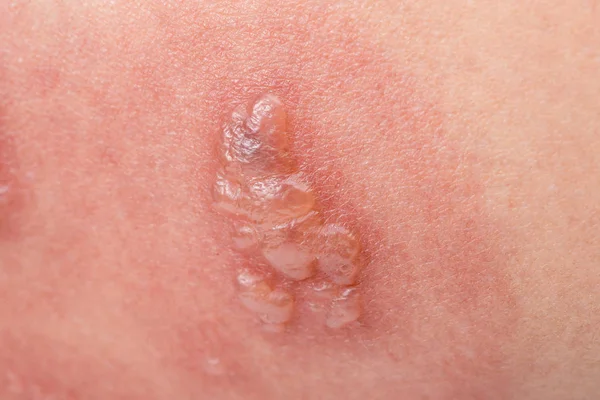 Shingles, Zoster or Herpes Zoster symptoms — Stock Photo, Image