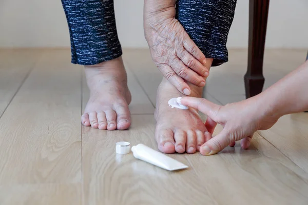 Donna anziana mettendo crema sui piedi gonfi da caregiver — Foto Stock