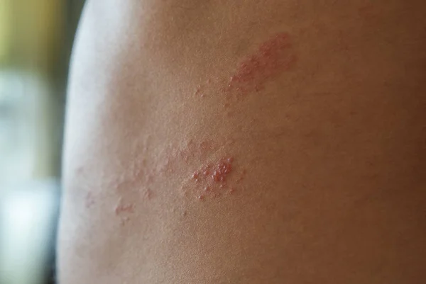 Zona la maladie images libres de droit, photos de Zona la maladie