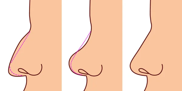 Пастическая операция на носу. До и после — стоковый вектор