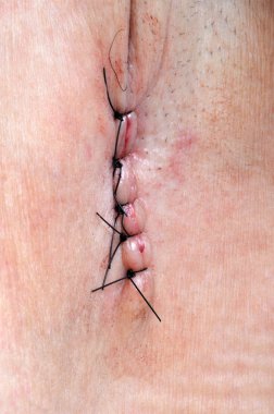 Dikişleri olan yara.