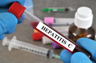Hepatit C kan testi. Kapatın.