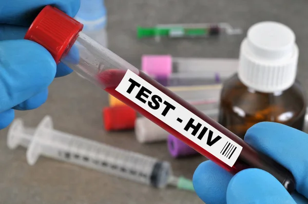 Close Hiv Hand Blood Test — Stock Photo, Image