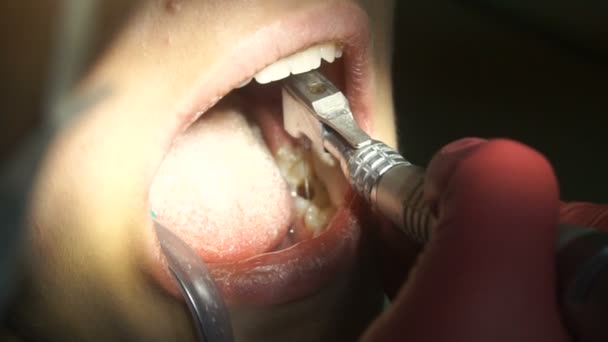 Boca feminina no dentista — Vídeo de Stock