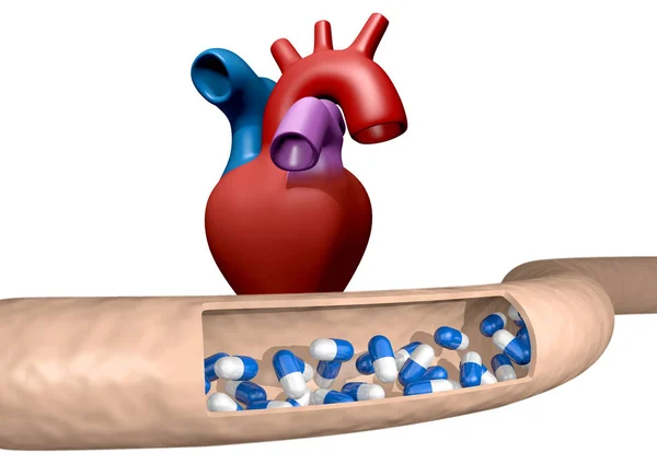 Corte la arteria que lleva medicamentos al corazón, renderizado 3D — Foto de Stock