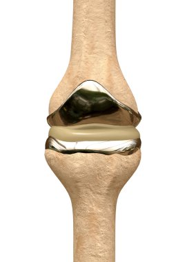 Osteoporozun ya da spor kazasının giydiği kemik yapılarının yerini alan metal diz protezi..