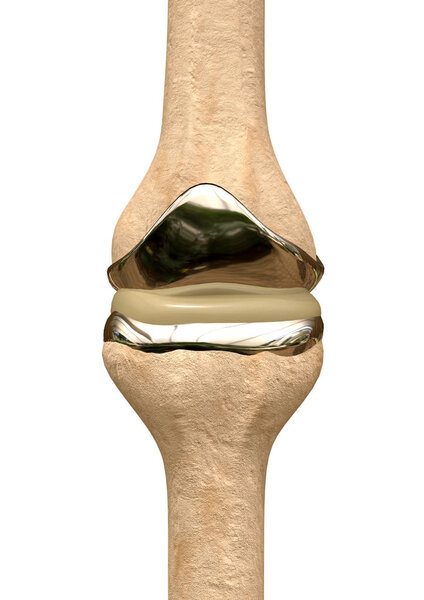 metallic knee prosthesis replacing bone structures worn by osteoporosis or a sports accident.