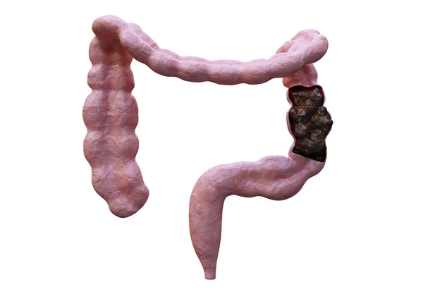 Intestinal Constipation Bowel Disorder Characterized Difficulty Excreting Faeces Laxatives Resolve — Stock Photo, Image