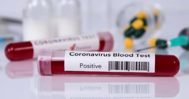 Yakın çekim kamera, virüs testi ve araştırması için Coronavirus hastalığı olan bir kan test tüpünün etrafında dönüyor. Dolly 4K çekti.