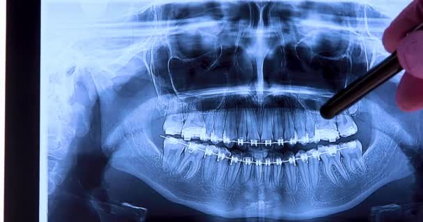 Lekarz Analizuje Prześwietlenie Zębów Implantami Radiografia Dla Koncepcji Badań Struktur — Wideo stockowe