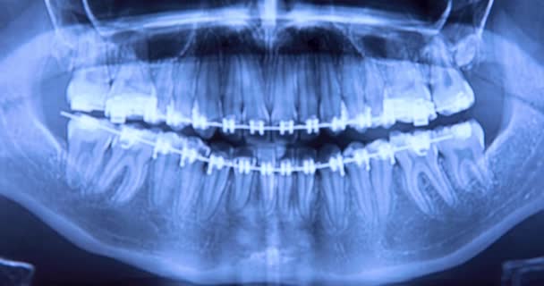 Tandröntgen Med Hängslen Röntgen För Tanduträtning Och Tandstrukturer Forskningskoncept Dolly — Stockvideo