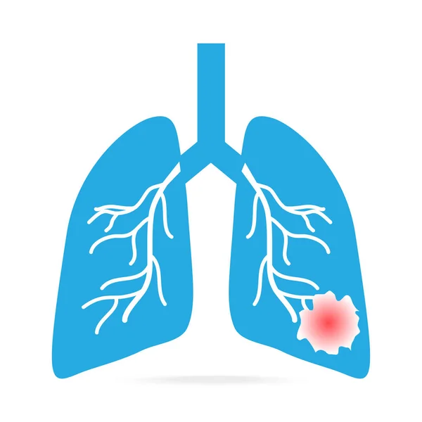 Cáncer de pulmón icono azul, ilustración concepto médico — Vector de stock