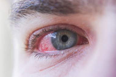 Makro kırmızı gözü konjonktivit enfeksiyonuyla kapat.