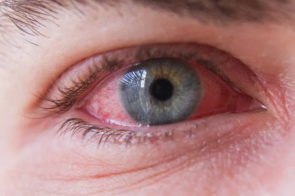 Macro Primer Plano Del Ojo Rojo Con Infección Por Conjuntivitis — Foto de Stock