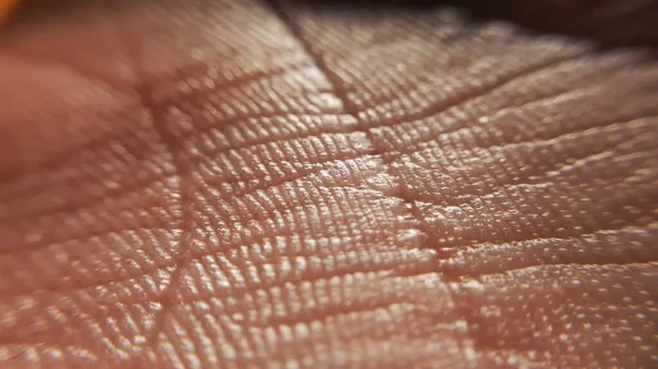 Contato Dermatite Conceito Doenças Pele Macro Pele Mão Humana Medicina — Fotografia de Stock