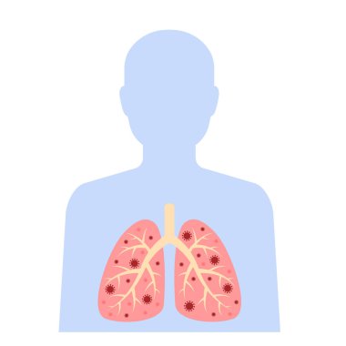 Solunum sistemi, enfekte olmuş insan silueti. Ciğerleri ve virüsü olan Corona virüsü tasarımı. Coronavirus hastalığı yayılmış, semptomlar. Vektör illüstrasyonu