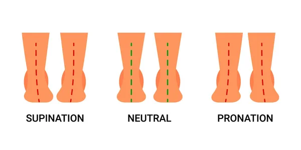 Fotdeformation, defekt, fotpatologier, plattfot. Normal mänsklig fot och fot med supination och pronation. Skillnaden mellan sjuka och friska fötter. Vektorillustration — Stock vektor