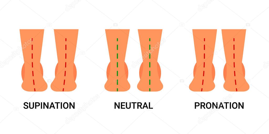 Foot deformation, defect, pathologies of foot, flatfoot. Normal human foot and the foot with supination and pronation. Difference between sick and healthy feet. Vector illustration