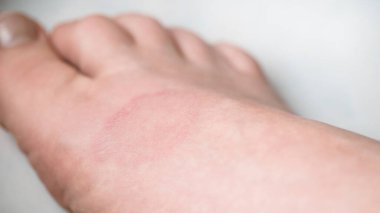 Human leg with Granuloma Annular or a pink lichen. Skin disease.  