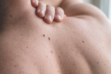Checking benign moles. Close up detail of the bare skin on a man back with scattered moles and freckles.