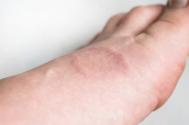 Human leg with Granuloma Annular or a pink lichen. Skin disease.  