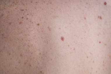 Checking benign moles. Close up detail of the bare skin on a man back with scattered moles and freckles.