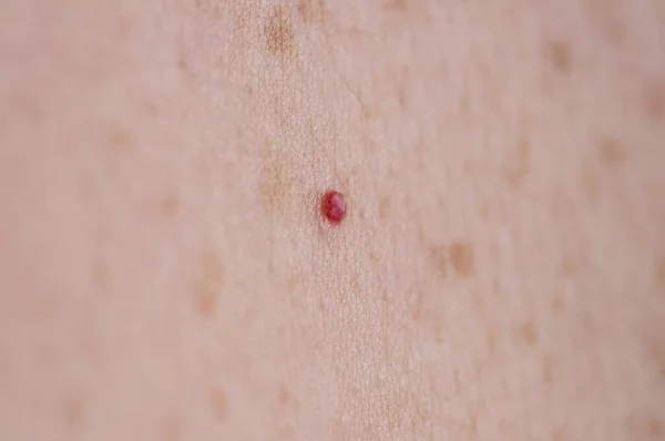 Checking benign moles. Close up detail of the bare skin on a man back with scattered moles and freckles. — 스톡 사진