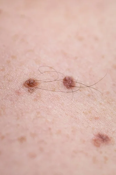 Sprawdzam łagodne pieprzyki. Bliższe szczegóły gołej skóry na plecach człowieka z rozrzuconymi pieprzykami i piegami. — Zdjęcie stockowe