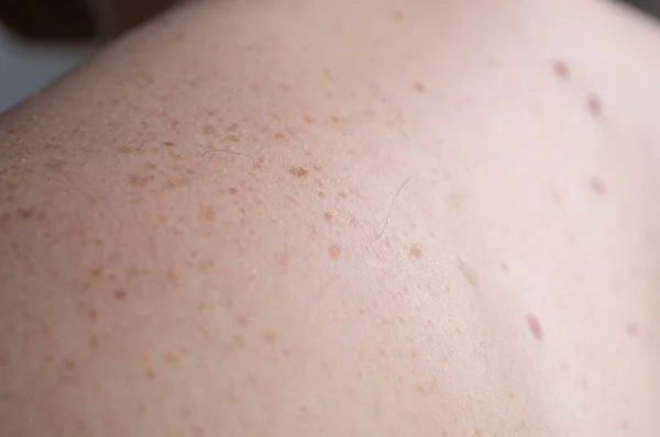 Kontrolle gutartiger Maulwürfe. Nahaufnahme von nackter Haut auf dem Rücken eines Mannes mit verstreuten Muttermalen und Sommersprossen. — Stockfoto