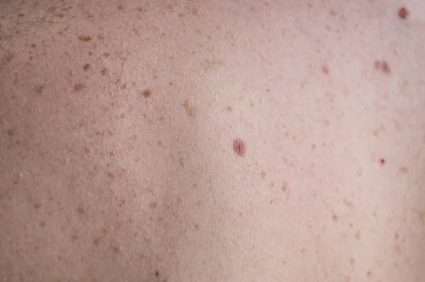 Checking benign moles. Close up detail of the bare skin on a man back with scattered moles and freckles. — Stock Photo, Image