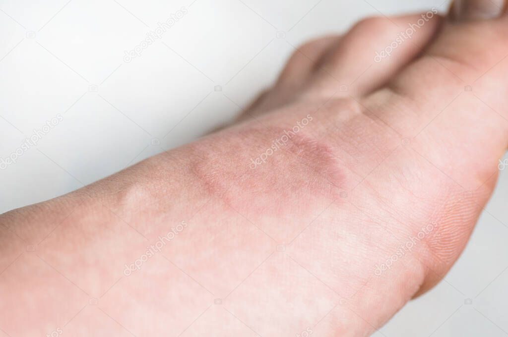 Human leg with Granuloma Annular or a pink lichen. Skin disease.  