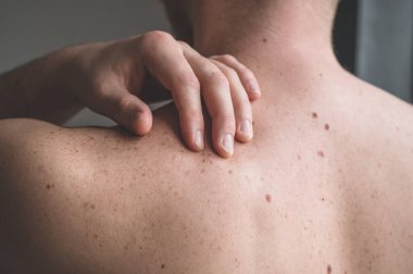 Checking benign moles. Close up detail of the bare skin on a man back with scattered moles and freckles.