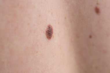 Checking benign moles. Close up detail of the bare skin on a man back with scattered moles and freckles.