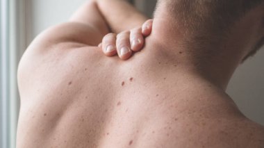Checking benign moles. Close up detail of the bare skin on a man back with scattered moles and freckles.