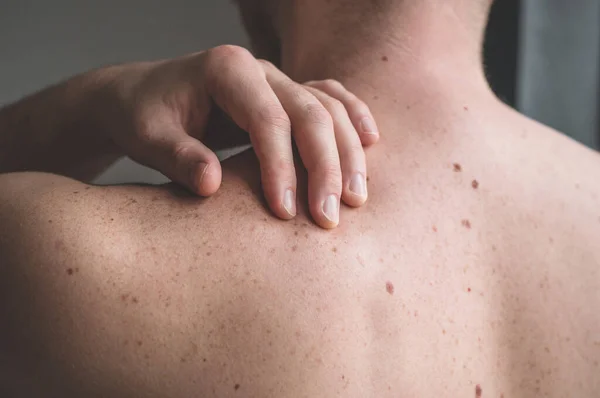 Je vérifie les taupes bénignes. Détail rapproché de la peau nue sur un dos d'homme avec des grains de beauté épars et des taches de rousseur . — Photo