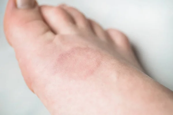 Человеческая нога с кольцевой грануломой или розовым лишайником. Кожные заболевания . — стоковое фото