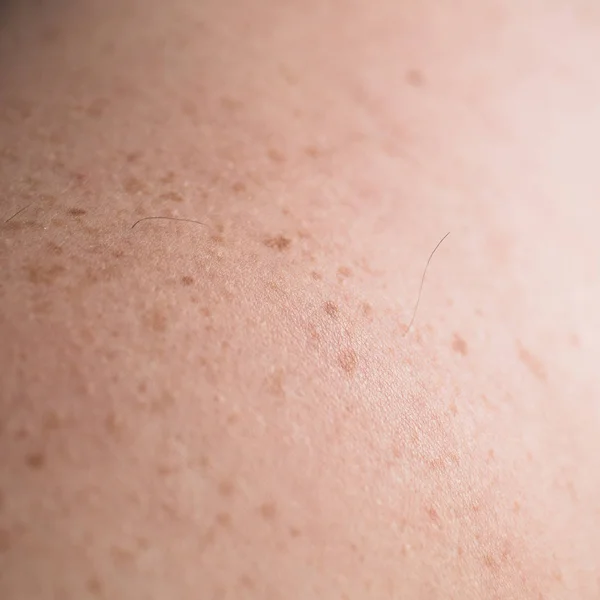 Comprobando lunares benignos. Detalle de cerca de la piel desnuda en un hombre con lunares dispersos y pecas . —  Fotos de Stock
