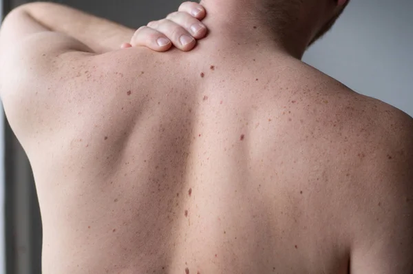 A verificar toupeiras benignas. Close up detalhe da pele nua em um homem de volta com toupeiras espalhadas e sardas . — Fotografia de Stock