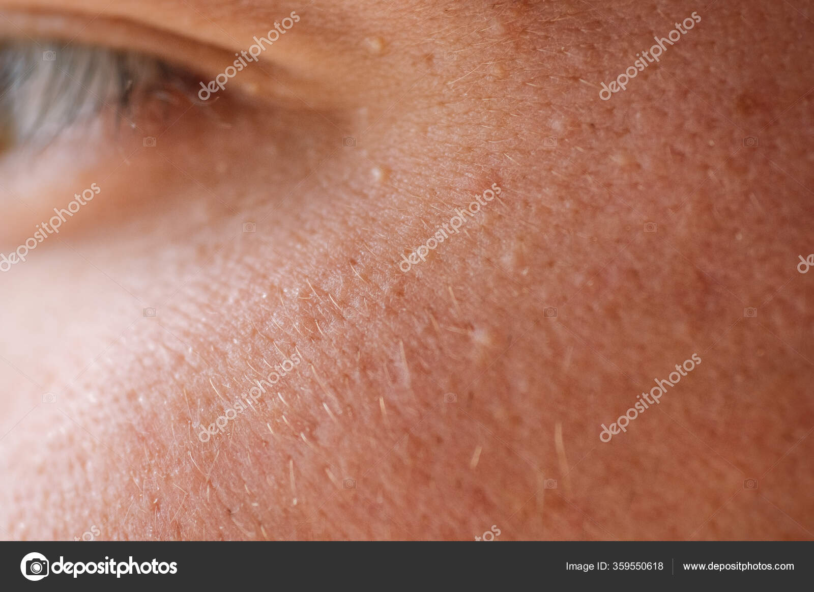 Просянка (белые угри, милиумы). Удаление на лице белые. Милиум просянка на лице. Ксантелазма (плоская ксантома век). Посттравматический милиум.