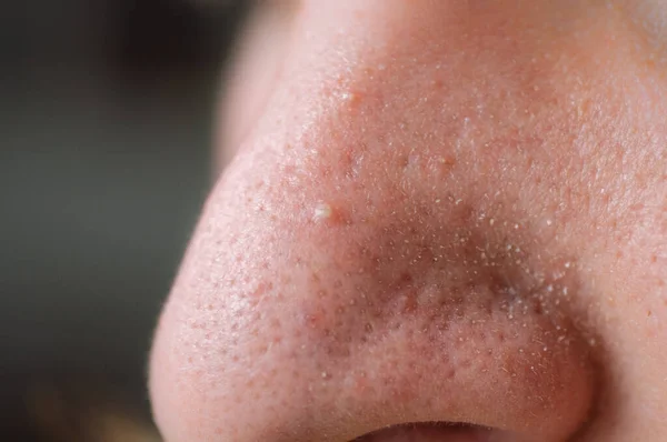 Poros trabados. Piel problemática. Post-acné, cicatrices y granos rojos supurantes en la cara de un joven . — Foto de Stock