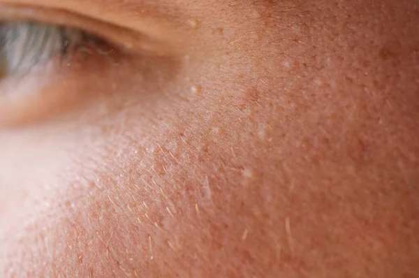 Milia (milio) - granos alrededor de los ojos en la piel. Ojos de hombre joven con papilomas pequeños en los párpados o crecimientos en la piel —  Fotos de Stock