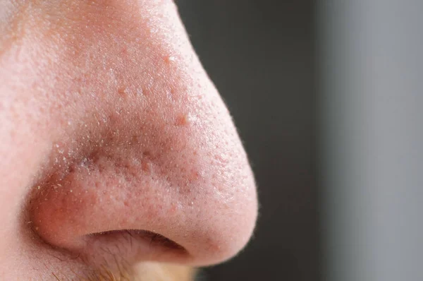 Poros trabados. Piel problemática. Post-acné, cicatrices y granos rojos supurantes en la cara de un joven . —  Fotos de Stock