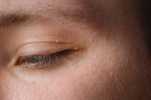 Milia (Milium) - espinhas em volta do olho na pele. Olhos de homem jovem com pequenos papilomas em pálpebras ou crescimentos na pele — Fotografia de Stock