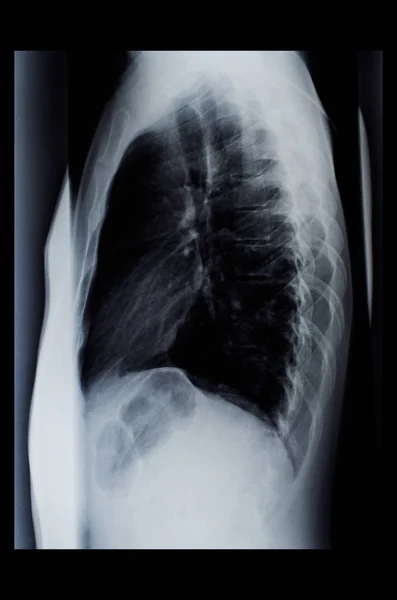 Fluorography of the spine — Stock Image Fluorography of the spine Royalty Free Stock Photos