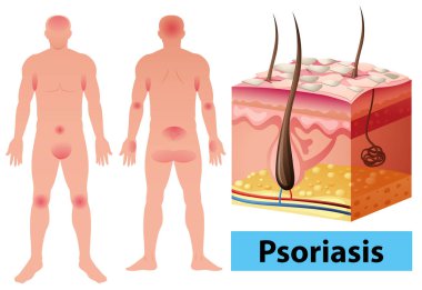 Diagram showing psoriasis in human clipart