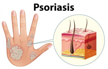 Diagram showing psoriasis on human hand clipart
